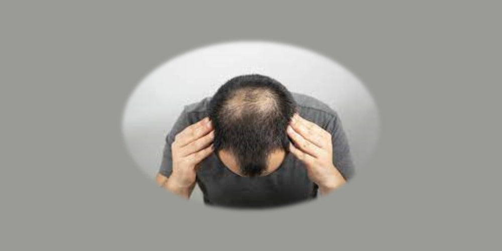 Gene identified for hair loss in hypotrichosis simplex