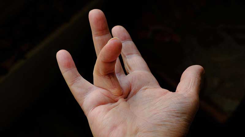 From Neanderthals to Vikings: A Journey Through Dupuytren’s Contracture